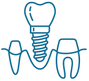 Implant Placement